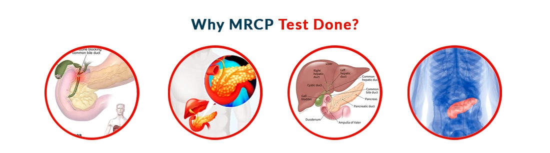 Why MRCP Test Done